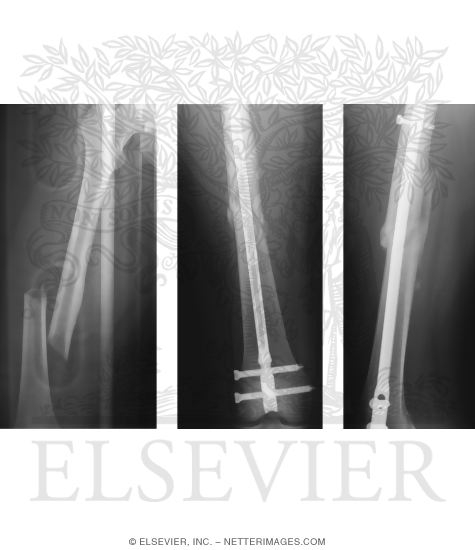 Watermarked preview of unlabeled image: Femoral Shaft Fracture