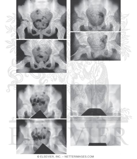 Watermarked preview of unlabeled image: Legg-Calv&eacute;-Perthes Disease