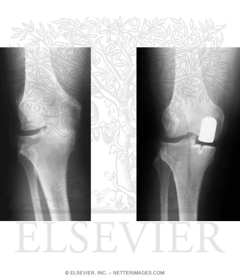 Watermarked preview of unlabeled image: Unicondylar Knee Arthroplasty