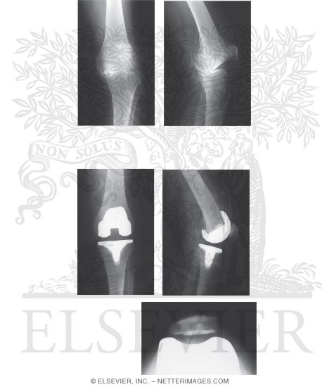 Watermarked preview of unlabeled image: Total Knee Arthroplasty