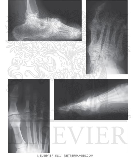 Radiographs Depicting Arthritis In Various Sites of the Foot