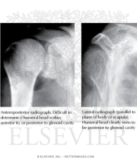 Watermarked preview of labeled image: Posterior Dislocation, Glenohumeral Joint