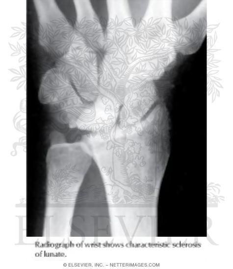 Watermarked preview of labeled image: Radiograph In Kienb&ouml;ck Disease