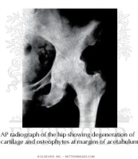 Watermarked preview of labeled image: Osteoarthritis of the Hip