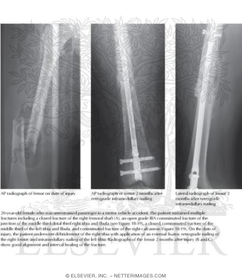 Watermarked preview of labeled image: Femoral Shaft Fracture