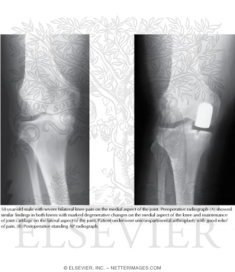 Watermarked preview of labeled image: Unicondylar Knee Arthroplasty