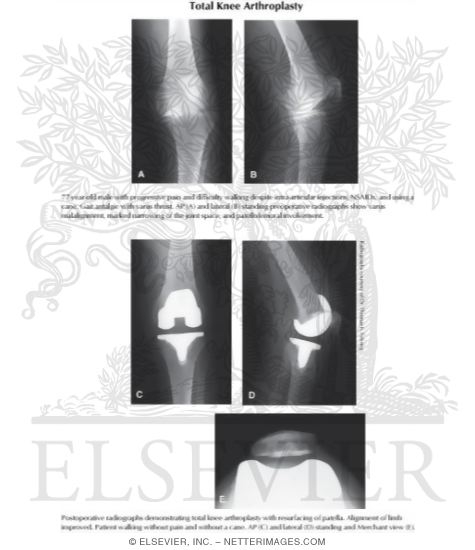 Watermarked preview of labeled image: Total Knee Arthroplasty
