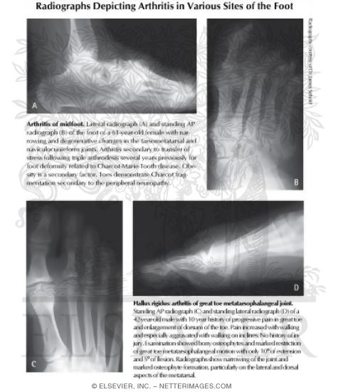 Watermarked preview of labeled image: K&ouml;hler Disease