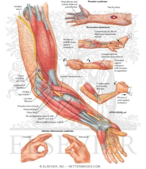Proximal Compression of Median Nerve