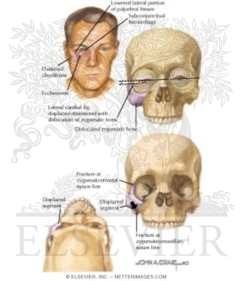 Zygomatic Fractures