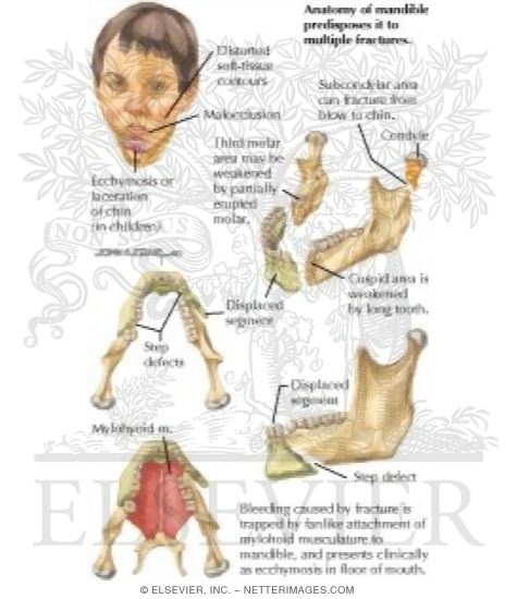 Watermarked preview of labeled image: Mandibular Fractures