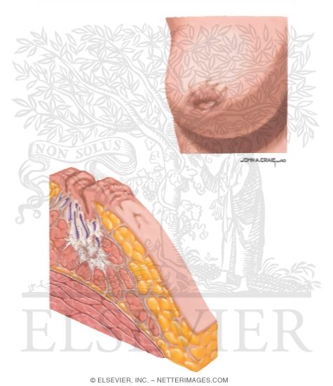 Nipple Retraction