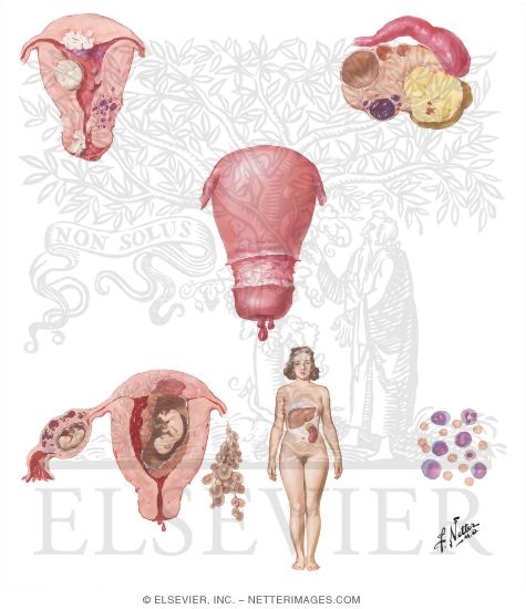 Dysfunctional Uterine Bleeding