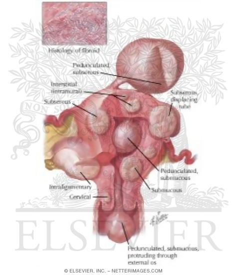 Myoma (Fibroid) I - Locations