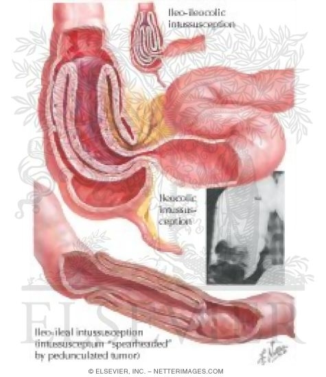 Intussusception