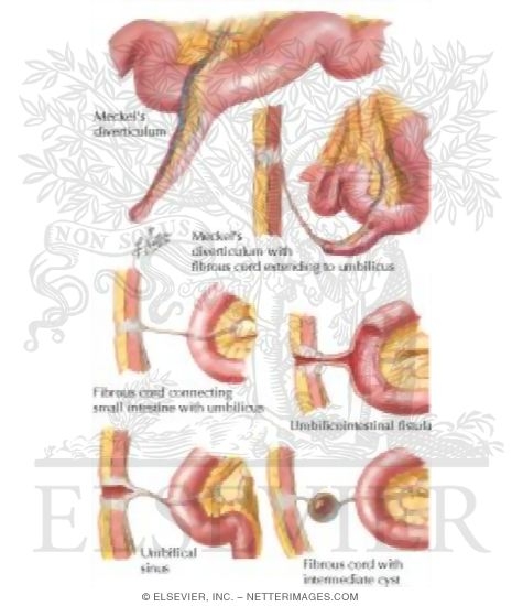 Watermarked preview of labeled image: Meckel's Diverticulum