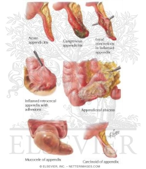 Watermarked preview of labeled image: Diseases of the Appendix: Inflammation, Mucocele, Tumors