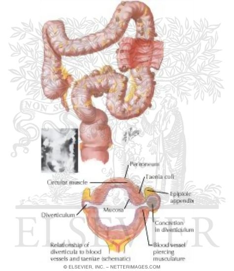 Watermarked preview of labeled image: Diverticulosis   