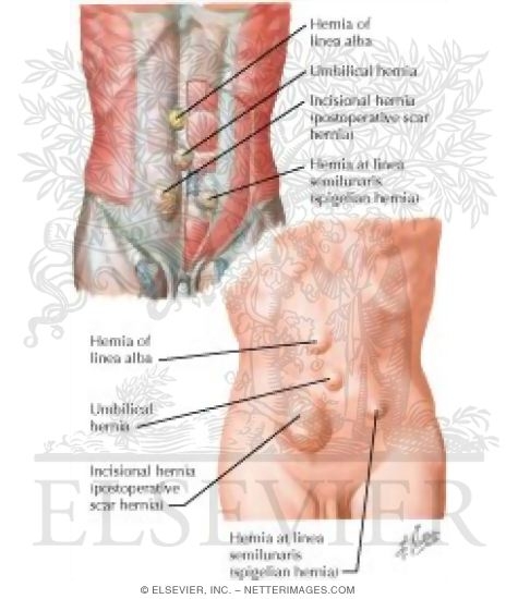 Hernia IV - Ventral Hernia