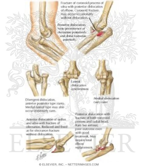 Dislocation of Elbow Joint