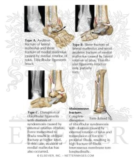 Rotational Fracture of Ankle Mortise