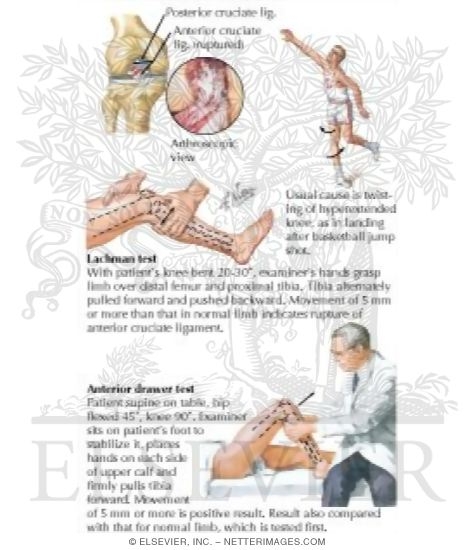 Rupture of Anterior Cruciate Ligament (ACL)