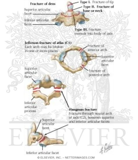 Watermarked preview of labeled image: Cervical Vertebral Fractures