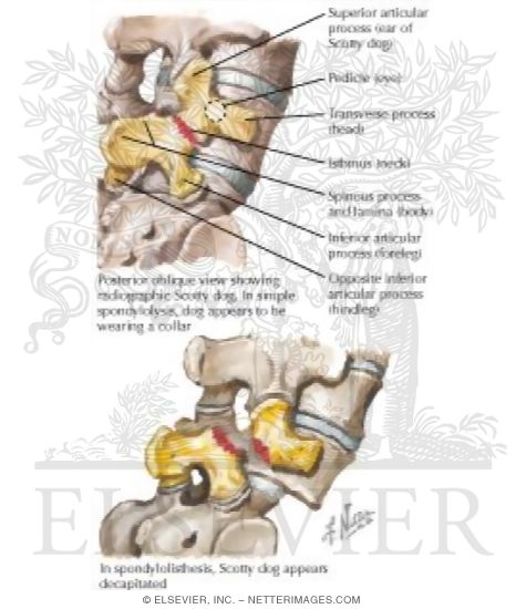 Watermarked preview of labeled image: Spondylolysis and Spondylolisthesis