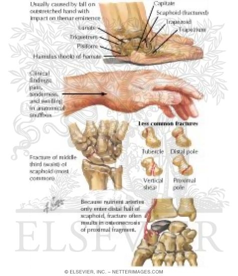 Watermarked preview of labeled image: Fracture of the Scaphoid
