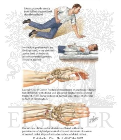 Colles' (Distal Radial) Fracture
