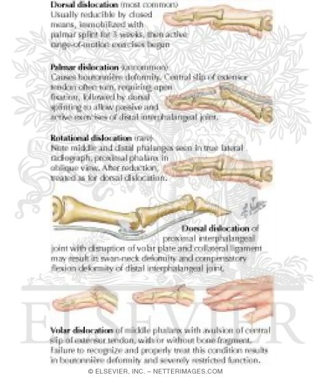 Proximal Interphalangeal Joint Dislocations