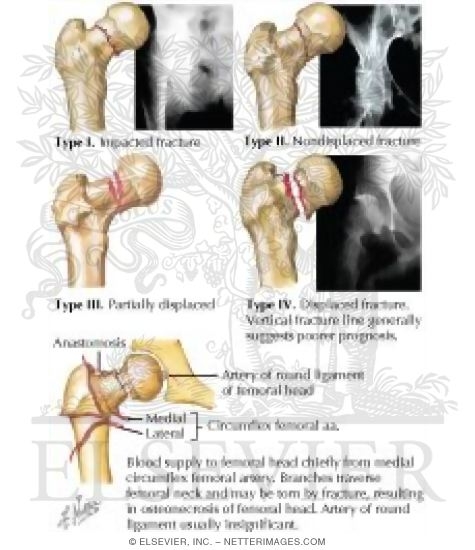 Watermarked preview of labeled image: Intracapsular Femoral Neck Fracture