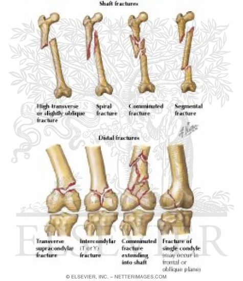 Fractures of the Shaft and Distal Femur