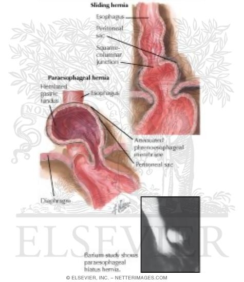 Hiatal Hernia