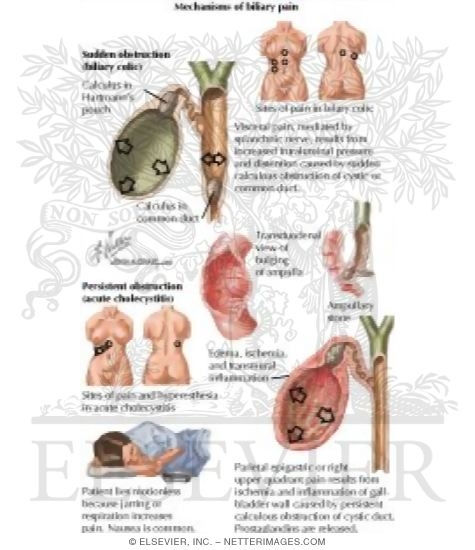 Cholelithiasis (Gallstones)