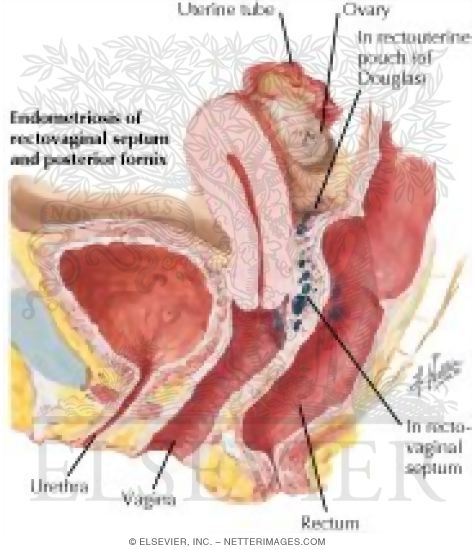 Endometriosis