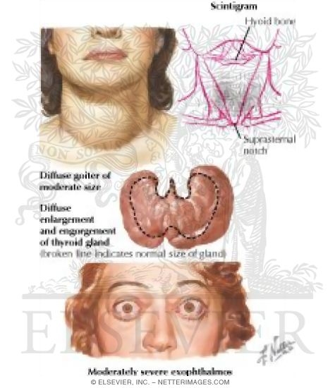 Graves Disease: Thyroid and Ocular Pathology