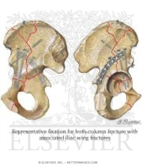Watermarked preview of labeled image: Acetabular Fracture Fixation