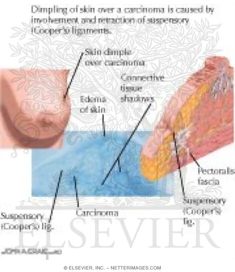Skin Dimpling