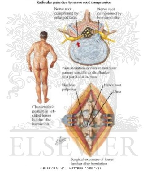 Watermarked preview of labeled image: Herniation of Lumbar Disc