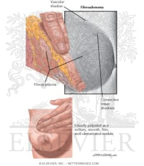Watermarked preview of labeled image: Fibroadenoma