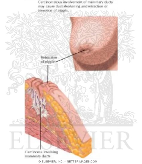 Nipple Retraction