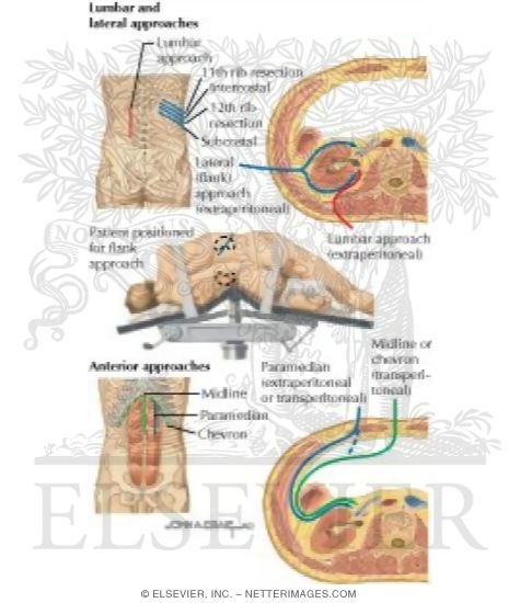 Watermarked preview of labeled image: Surgical Approach to the Kidney