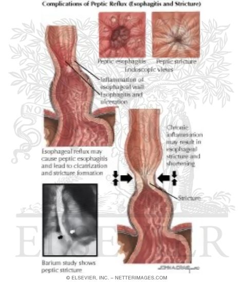 Watermarked preview of labeled image: Complications of Peptic Reflux (Esophagitis and Stricture)
