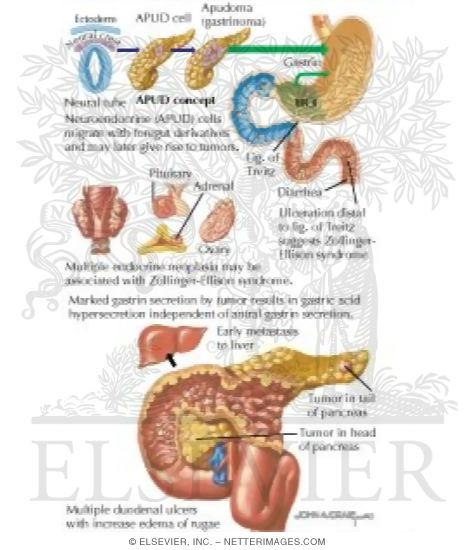 Zollinger-Ellison Syndrome