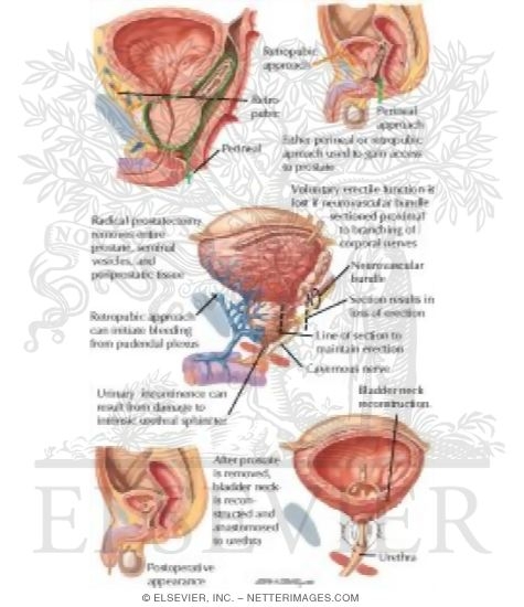 Radical Prostatectomy