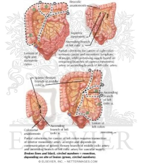 Watermarked preview of labeled image: Surgical Resection of Colon Cancer