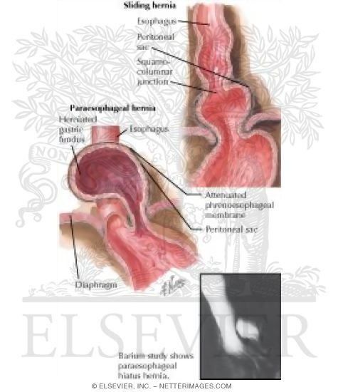 Hiatal Hernia