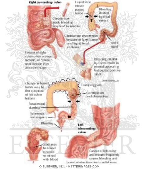 Clinical Manifestations of Colorectal Cancer
