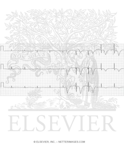 Watermarked preview of unlabeled image: T-Wave Changes Induced By a Recent Ischemic Event